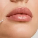 01 relleno labios