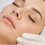 05 mesoterapia